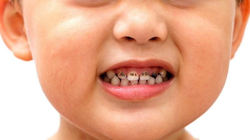 Почернение молочных зубов у детей: советы от врача-стоматолога Чесноковой Галины Александровны